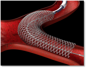 Nickel titanium alloy heart stent