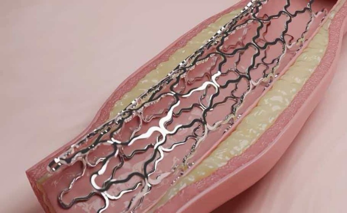 Vascular filter